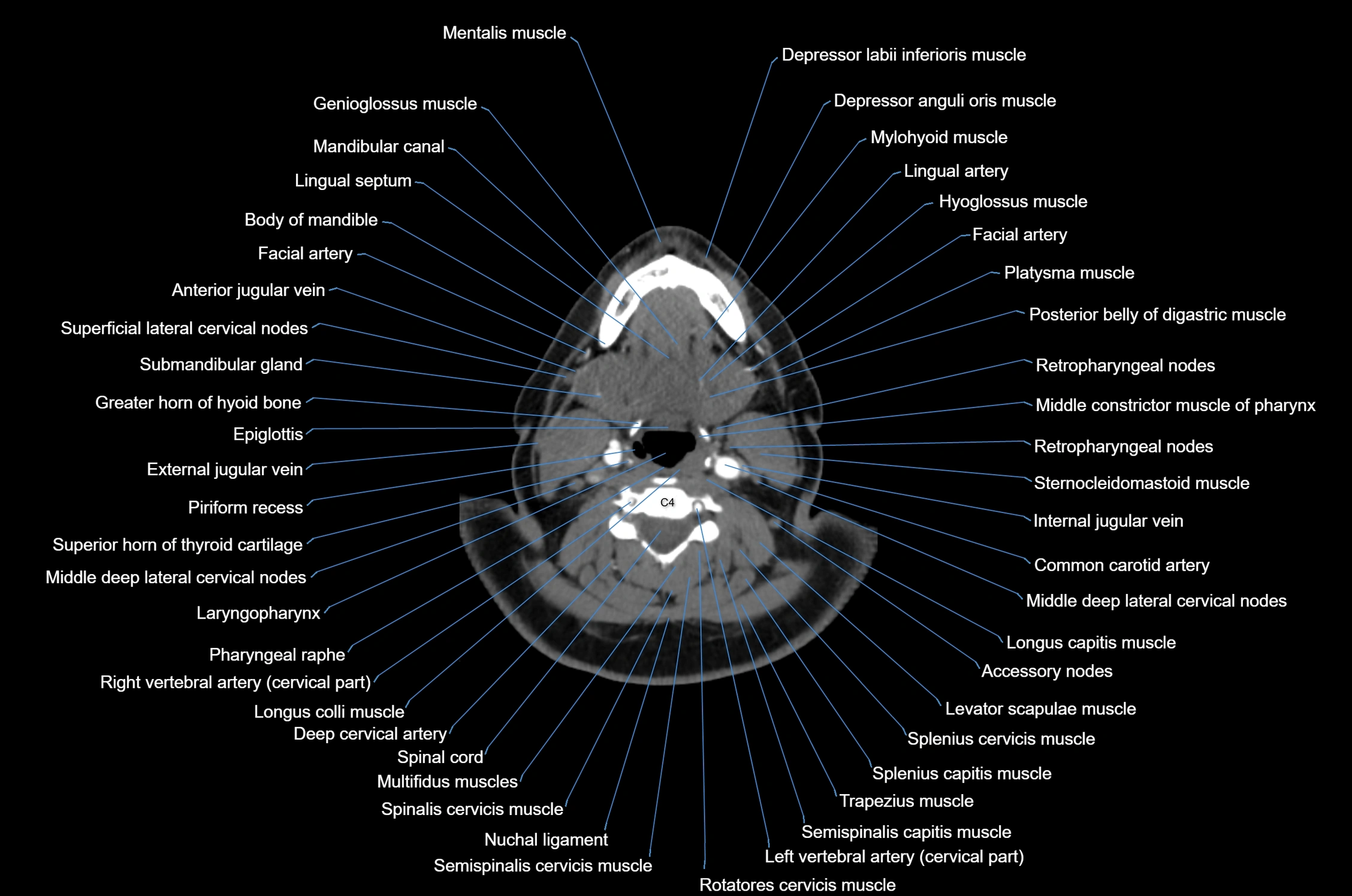 CT Neck axial cross sectional anatomy radiology image-img-00001-00037.webp